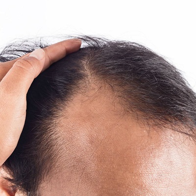 زراعة الشعر الدائم في حالات الصلع الذكوري - ديناميك دبي