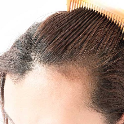 كيفية زيادة معدل نمو الشعر بعد زراعة الشعر