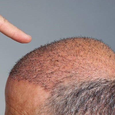 جراحة زراعة الشعر بدون ندبات في دبي وأبو ظبي والشارقة كلفة