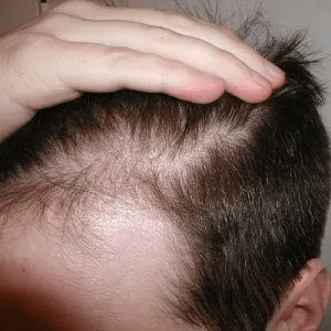 ما هي الآثار الجانبية استبدال الشعر غير الجراحي في دبي؟