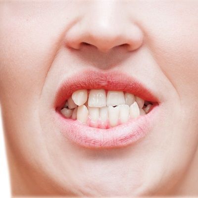 ما هي تكلفة علاج الأسنان الملتوية في دبي؟