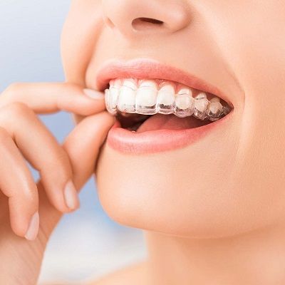 تقويم الأسنان الشفاف في دبي