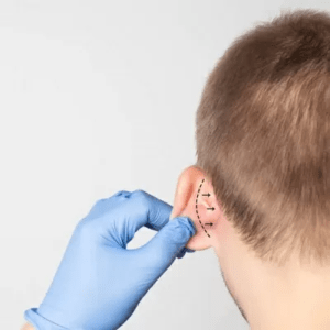 جراحة تجميل الأذن للأطفال والكبار