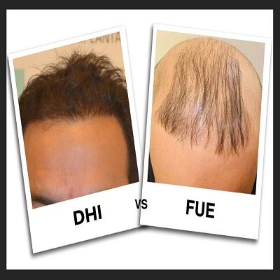 زراعة الشعر بتقنية DHI مقابل FUE
