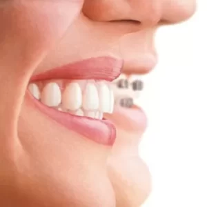 إنفزلاين مقابل تقويم الأسنان: دليل كام