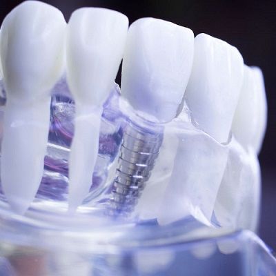 فوائد زراعة الأسنان في دبي