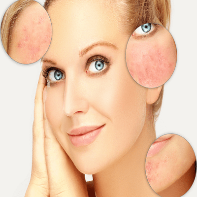 علاج الوردية في دبي – تقليل احمرار الوجه