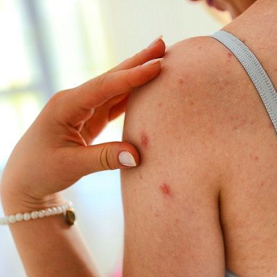 هل تزعجك البثور الموجودة على ذراعيك دبي وهنا العلاجات للتخلص منها
