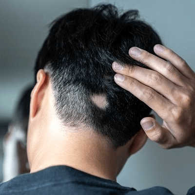 الثعلبة البقعية: هل يمكن علاج تساقط الشعر غير المكتمل؟
