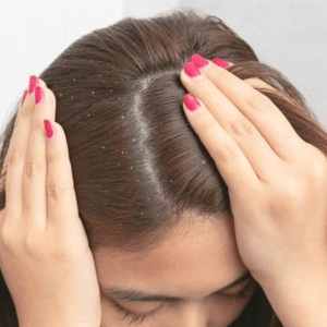علاج فطريات فروة الرأس وتساقط الشعر في دبي