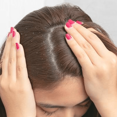 علاج فطريات فروة الرأس و تساقط الشعر في دبي وأبو ظبي
