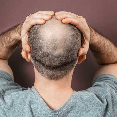 كيفية علاج تساقط الشعر الصدغي في دبي