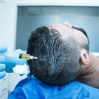 استعادة الشعر بالبلازما الغنية بالصفائح الدموية في دبي