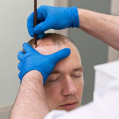 التكنولوجيا والمرافق المتقدمة لزراعة الشعر بتقنية FUE في دبي