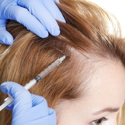 الرحلة إلى شعر أكثر كثافة: أفضل علاج بالبلازما الغنية بالصفائح الدموية