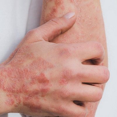 مشاكل الجلد في الشتاء: التعامل مع الأمراض الجلدية في دبي