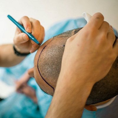 8 نصائح للشفاء السريع بعد زراعة الشعر