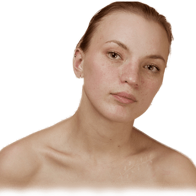 تقنيات علاج الندبات الناتجة عن التصبغ الجلدي