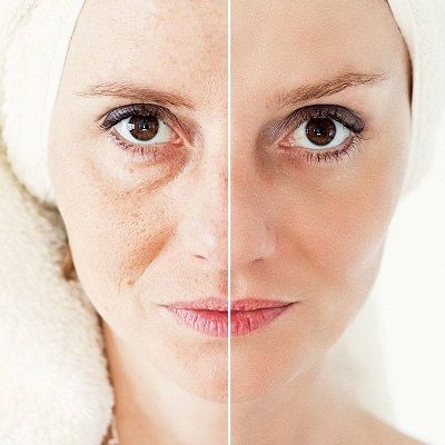 احصل على مظهر أصغر سنًا من خلال علاج شد الجلد وتحديد الوجه