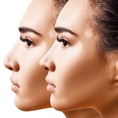 تجميل طرف الأنف في دبي, وأبو ظبي والشارقة - تكاليف وعروض