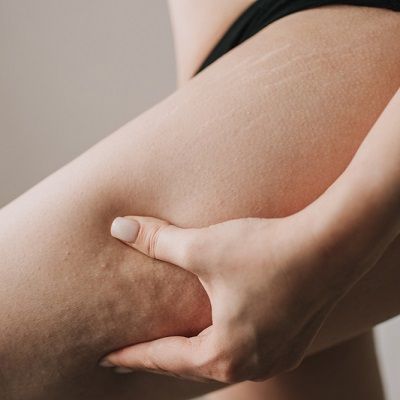 علاج السيلوليت في دبي وأبو ظبي والعين | السيلوليت