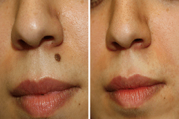 أفضل علاج لإزالة الشامة في دبي