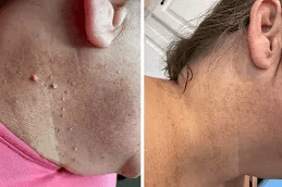 إزالة علامات الجلد في دبي