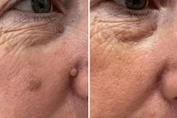 إزالة علامات الجلد