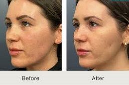 تجديد البشرة في أبوظبي