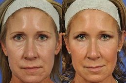 تجديد البشرة في دبي