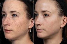 تجديد البشرة