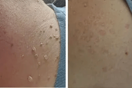 تكلفة إزالة علامات الجلد