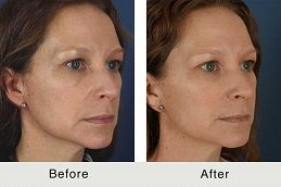 تكلفة تجديد البشرة