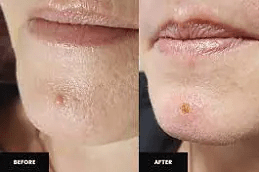 عيادات إزالة علامات الجلد