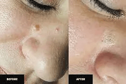 نتائج إزالة علامات الجلد