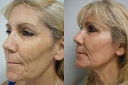 نتائج تجديد البشرة