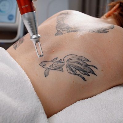 إزالة الوشم بالليزر في دبي | تخلص من التاتو بأمان وفعالية