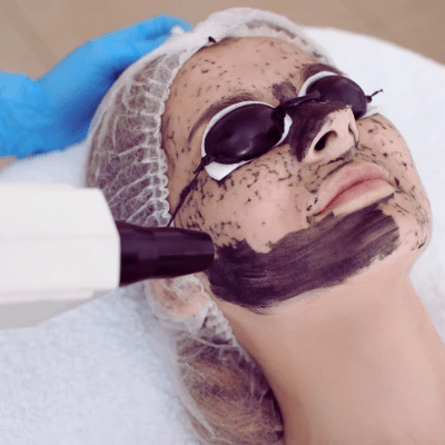 تقشير الكربون بالليزر سبيكترا في دبي | Laser Carbon Peel