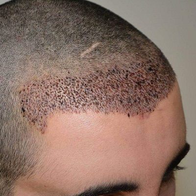 كيف يبدو شكل 2000 طعوم شعرية؟