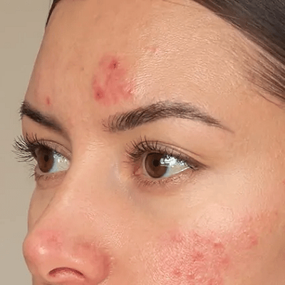 كيف أتخلص من الحبوب الموجودة في وجهي؟