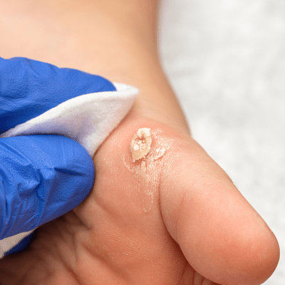 كيفية التخلص من الثآليل نهائيا؟