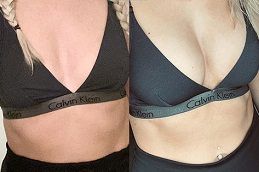 تكبير الثدي في أبوظبي