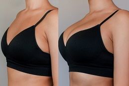 تكبير الثدي