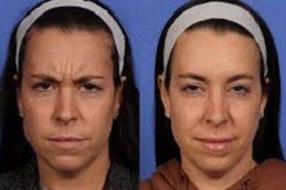 بوتوكس في العين