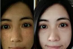 تكلفة تبييض البشرة الدائم في دبي