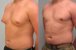 جراحة التثدي في أبوظبي