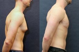 جراحة التثدي في العين