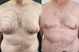 جراحة التثدي