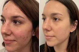 جلسة هيدرافيشل للوجه