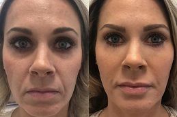 حقن البوتوكس السحري